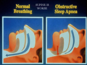 OSA:  Obstructive Sleep Apnoea / Apnea